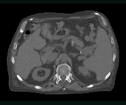 Paired real abdominal CT reference plane on the same physical geometry as the synthetic CT.