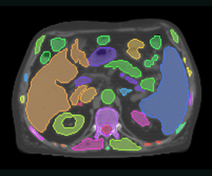 Real TotalSegmentator five-model anatomy labels overlaid on the abdominal synthetic CT plane.