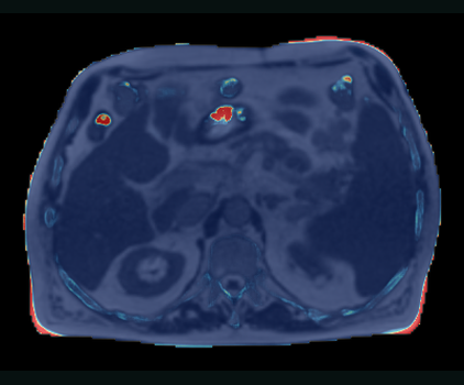 Reference-free ensemble-uncertainty heat map from the completed 15-state ImpactSynth App workflow over the MR anatomy.