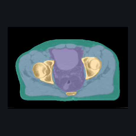 The same CT slice with the ImpactSeg anatomy labels overlaid.