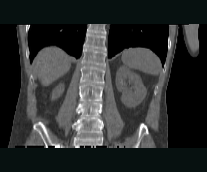 Coronal view of the real fixed abdominal CT that defines the registration target and output geometry.