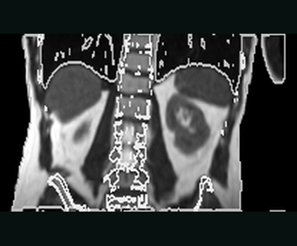 Coronal view of the real moved abdominal MR after ConvexAdam Composite registration on the fixed CT grid.