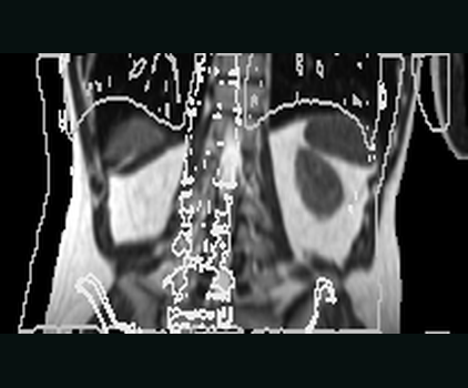 Coronal view of the real moving abdominal MR before registration, with fixed CT contours showing the controlled spatial offset.