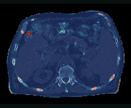 Per-voxel absolute-error heat map from the completed ImpactSynth evaluation over the paired CT anatomy.