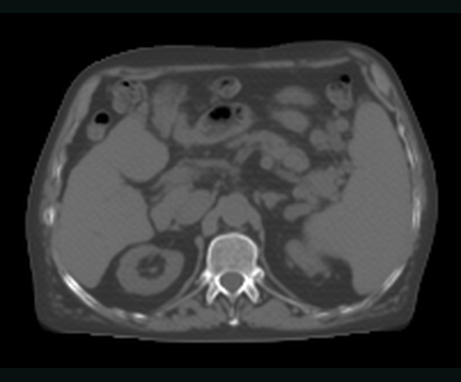 MR-to-synthetic-CT result
